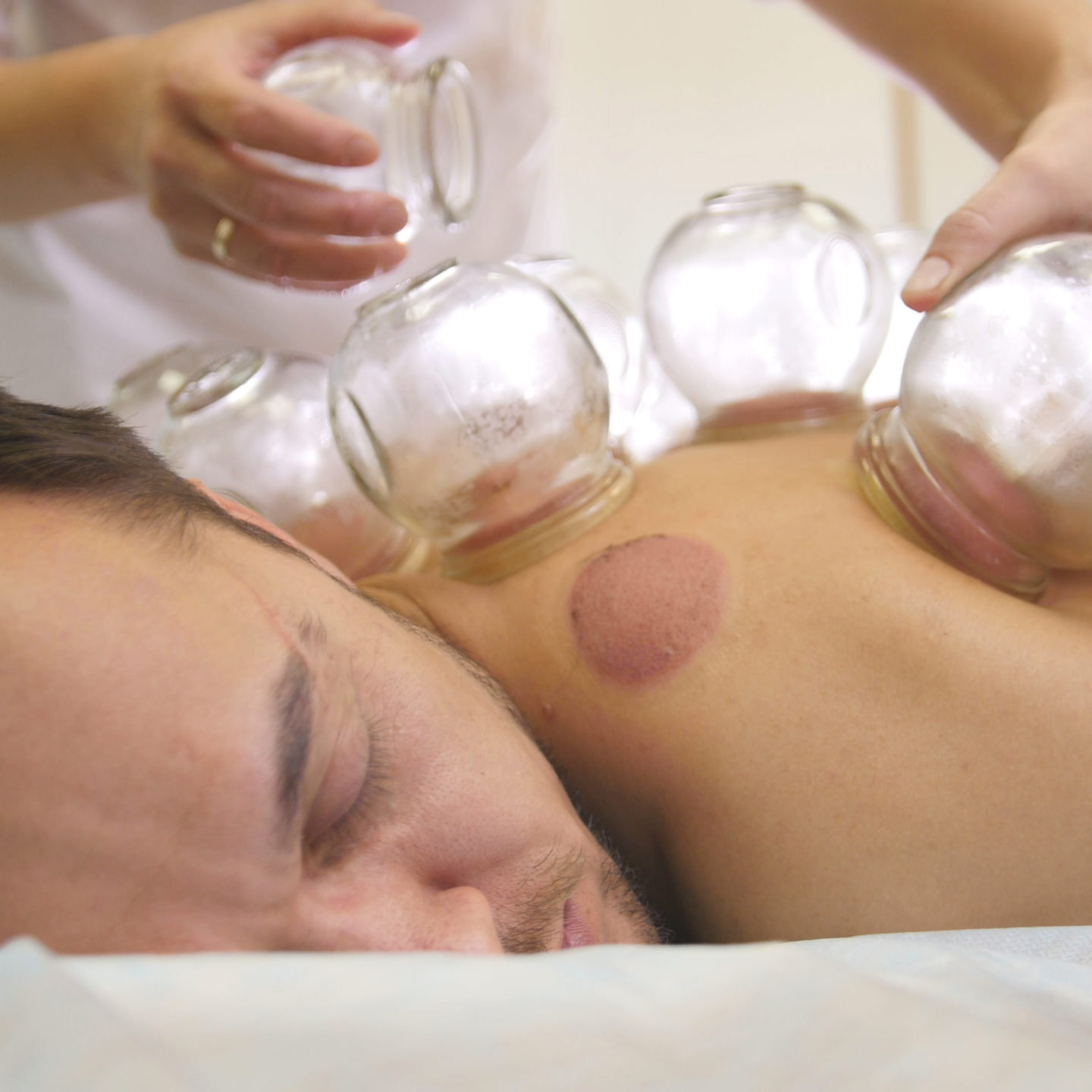 Cupping Therapy